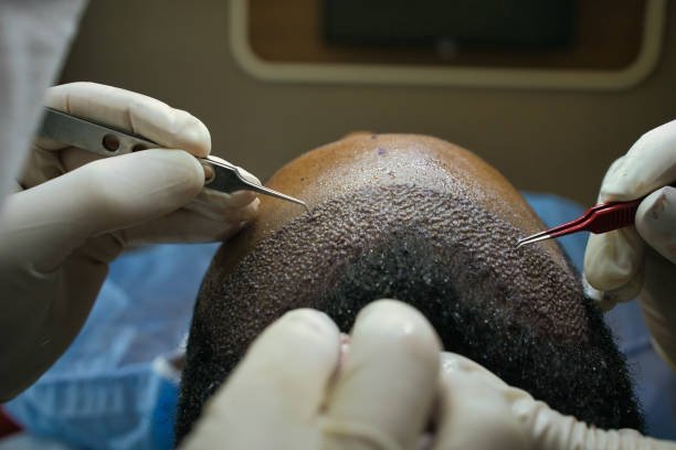 Haartransplantation in Ankara im Jahr 2025: Innovationen, Ablauf und Vorteile