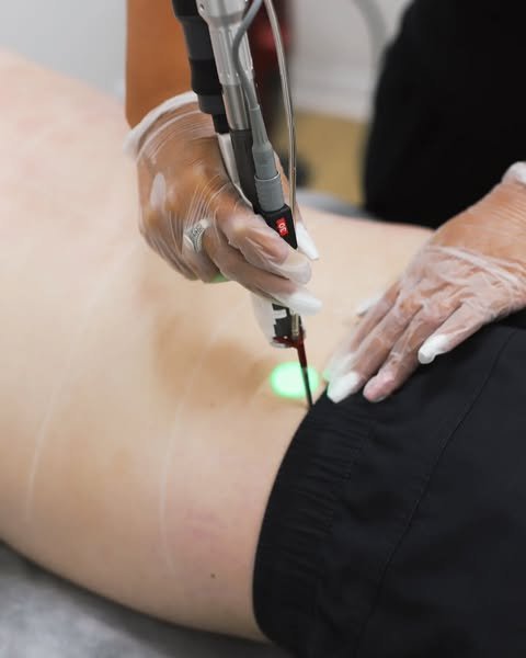 Laser-Epilation in der Forest Klinik