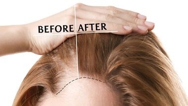 HAIR TRANSPLANTATION