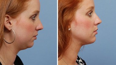 DOUBLE CHIN LIPOSUCTION