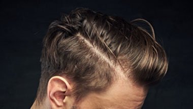 HAIR TRANSPLANT APPLICATIONS