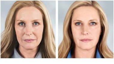 FACE LIFT SURGERY