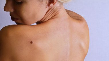 SKIN TAG REMOVAL